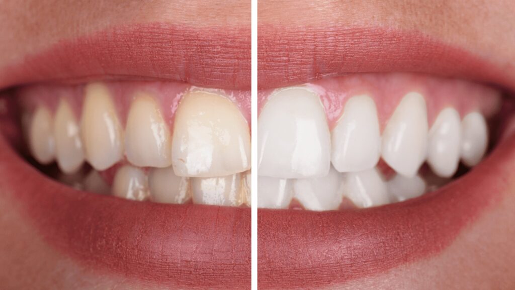 How To Make Your Teeth Whiter