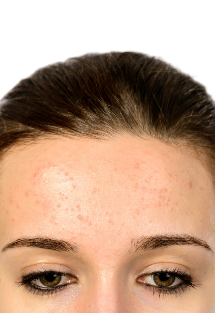 Grainy Skin Texture On Face