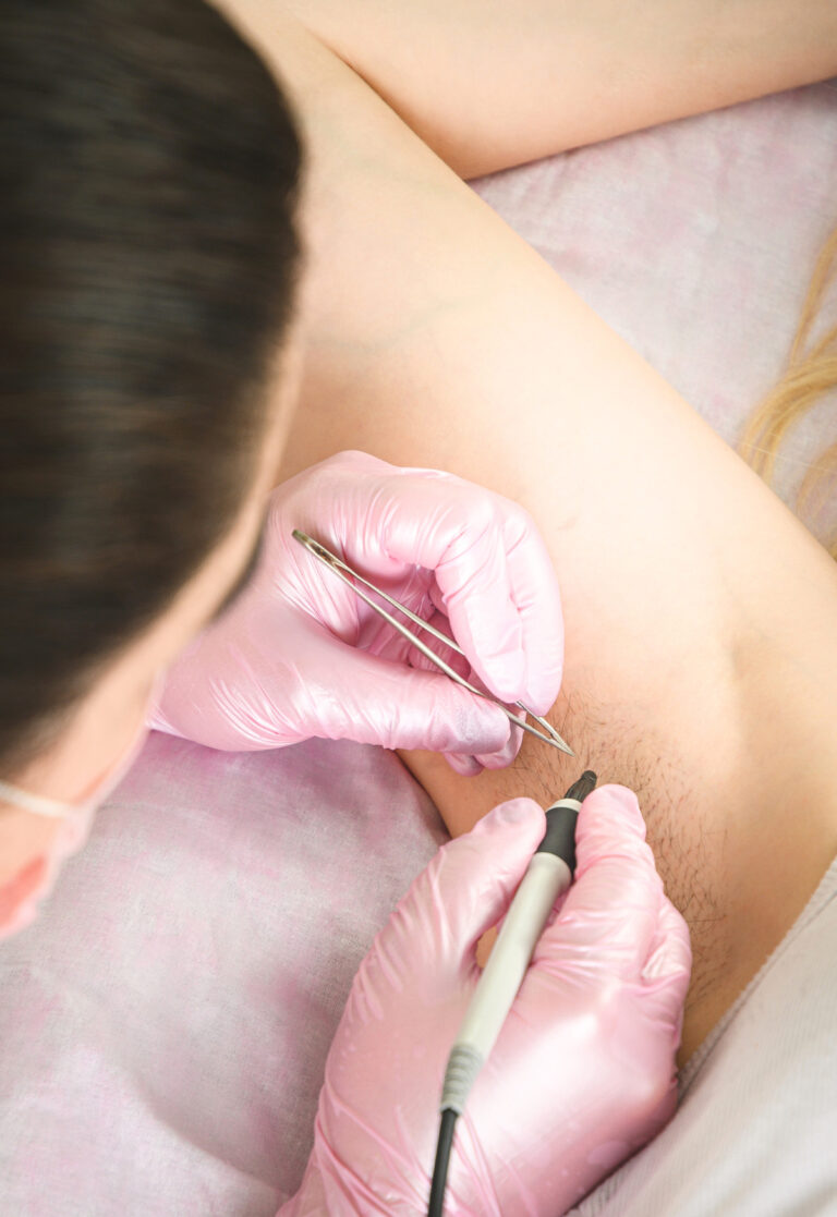 Is Electrolysis Hair Removal Right For You? Find Out Now