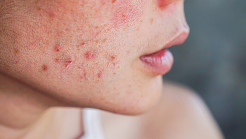 Can Dry Skin Cause Acne