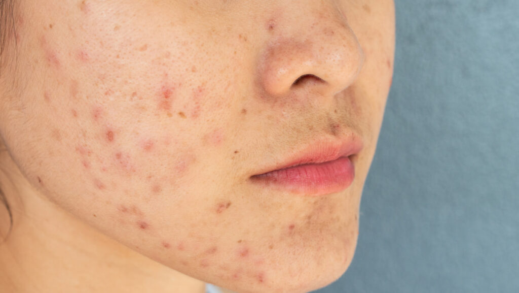 How To Remove Dark Spots Caused By Pimples
