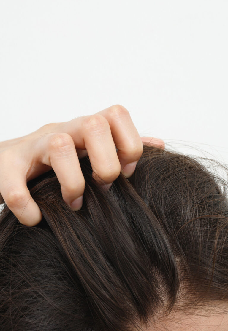 Scalp Psoriasis Symptoms: 7 Telltale Signs You Shouldn’T Ignore