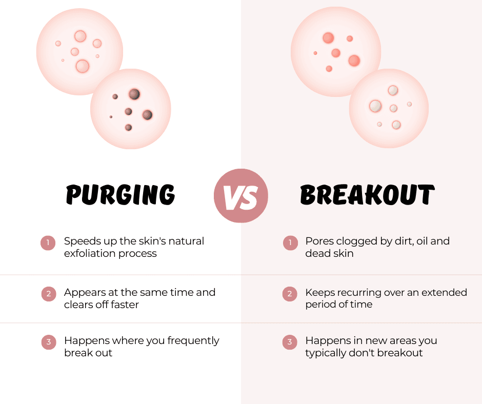 Purging Vs Breakout | Does Azelaic Acid Cause Purging?